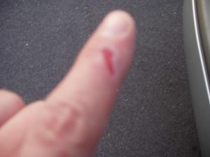 Injury From Tungsten Grinding